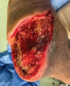 Clean wound after surgical debridements - SingHealth Duke-NUS Vascular Centre