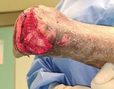 Fish skin dermal substitute - SingHealth Duke-NUS Vascular Centre