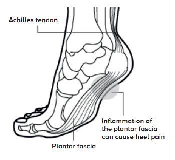 Plantar Fasciitis  - SingHealth Duke-NUS Sport & Exercise Medicine