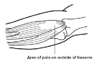 Tennis Elbow  - SingHealth Duke-NUS Sport & Exercise Medicine