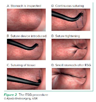 The ESG Procedure