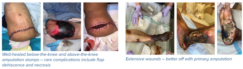 Well-healed amputation stumps and extensive wounds better with primary amputation - SingHealth Duke-NUS Vascular Centre