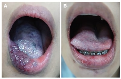 Venous malformations - SingHealth Duke-NUS Vascular Centre