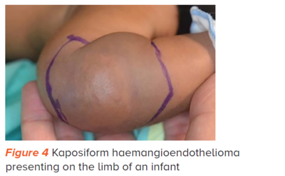 Kaposiform haemangioendothelioma - SingHealth Duke-NUS Vascular Centre