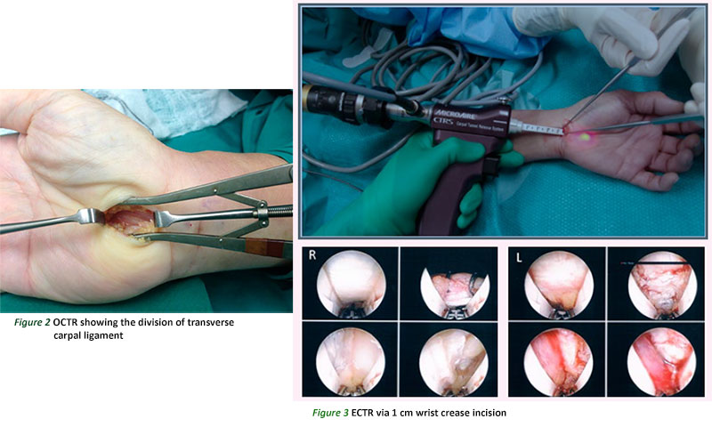 Open carpal tunnel release and Endoscopic carpal tunnel release at SGH.