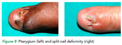 Pterygium and split nail deformity - SGH.