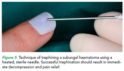 Technique of trephining a subungal haematoma using a heated, sterile needle by SGH.