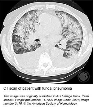 haematologic-emergencies-ct-scan-fungal-pneumonia-sgh-blood-cancer-centre