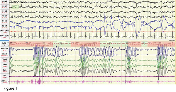 Obesity and Obstructive Sleep Apnoea - SGH