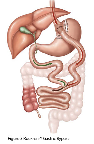 Roux-en-Y Gastric Bypass