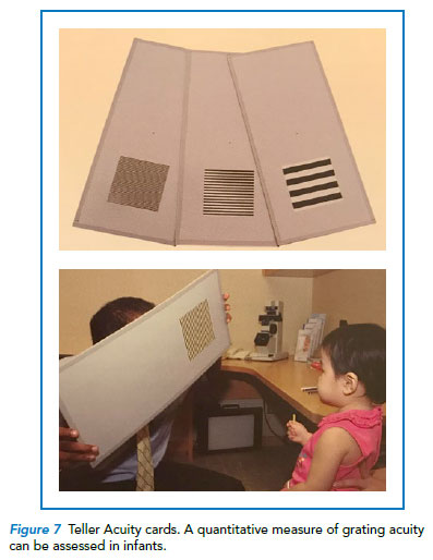 Clinical assessment of a child with a suspected squint by Singapore National Eye Centre