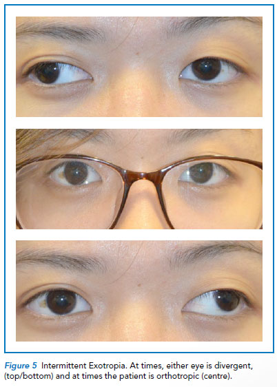 Intermittent exotropia - Singapore National Eye Centre