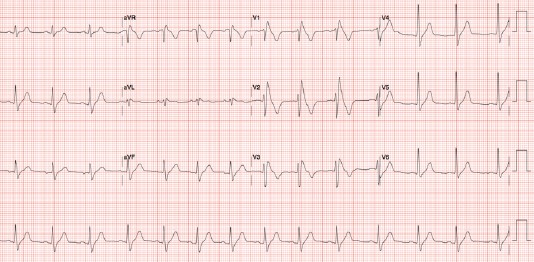 ecg