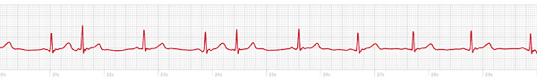 Sample ECG Atrial Ectopic