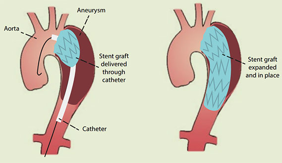 TEVAR procedure illustration