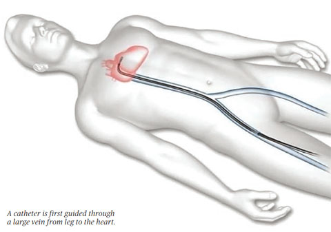 catheter mitraclip