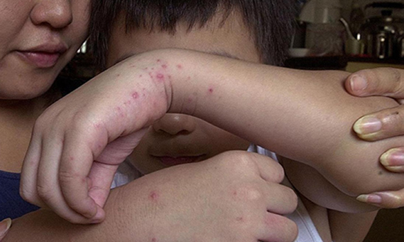  ​is key to prevention. Photo SingHealth Polyclinics, Shin Min Daily News