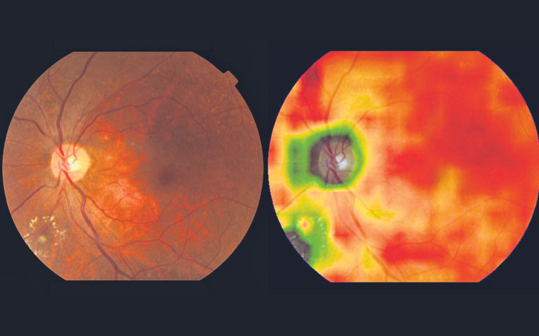 next to a heat map generated by the AI system which highlights where the DR lesions are.