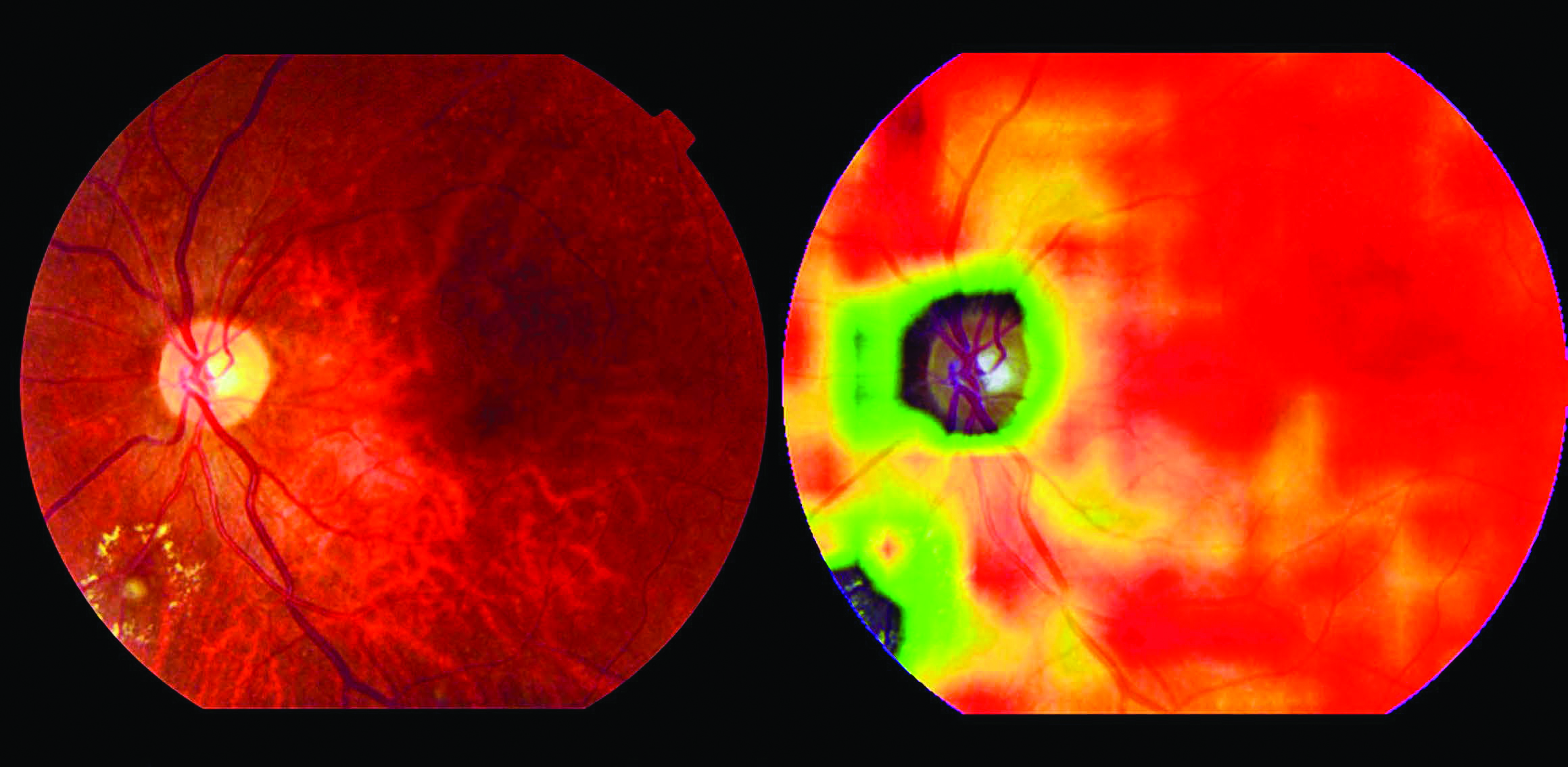 which highlights where the DR lesions are. PHOTO SINGAPORE NATIONAL EYE CENTRE OCULAR READING CENTRE