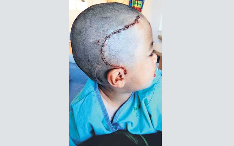 ​on Javier Lim’s skull are proof of the painful operations he has had over the past three years. 