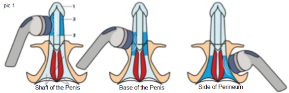 erectile dysfunction