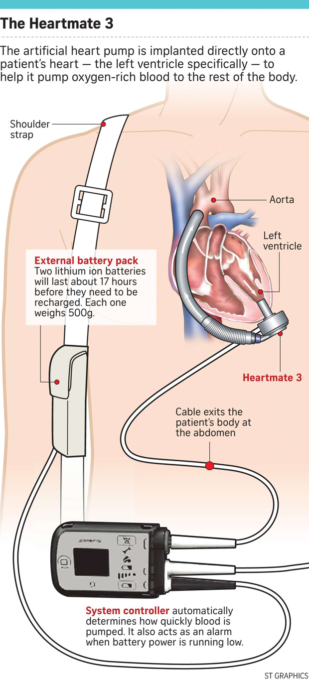 1st Asian to get new heart pump in NHCS