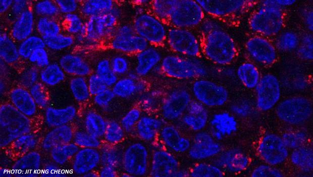  ​The photo above shows cancer cells given a combination therapy. The study found that the use of an anti-malarial drug together with the blocking of an enzyme called Casein Kinase 1 alpha was able to effectively treat human colon and bladder tumours grown in lab mice.