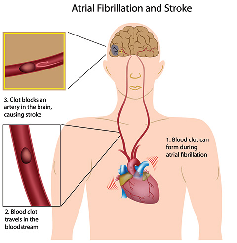 Atrial fibrillation increases the risk of stroke | SingHealth