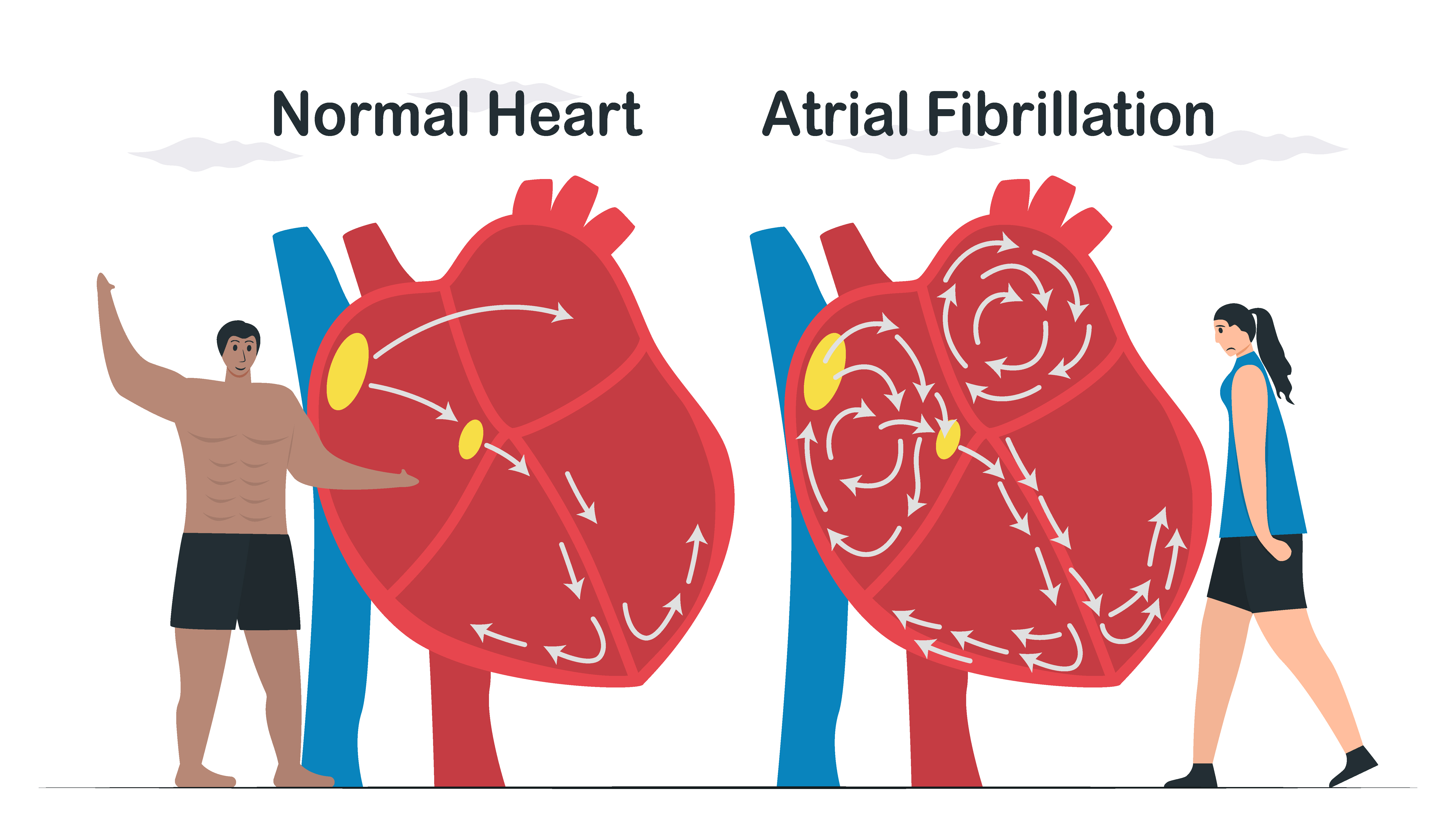 Atrial fibrillation in the heart | SingHealth