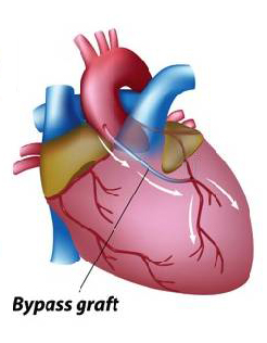 Coronary artery bypass graft (CABG) in the heart | SingHealth