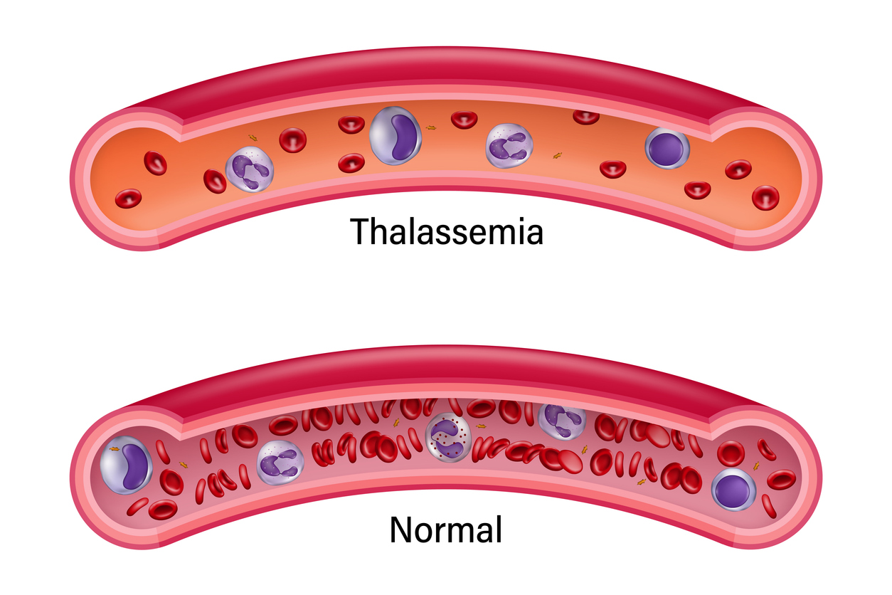 Comparison between normal red blood cells and thalassemia