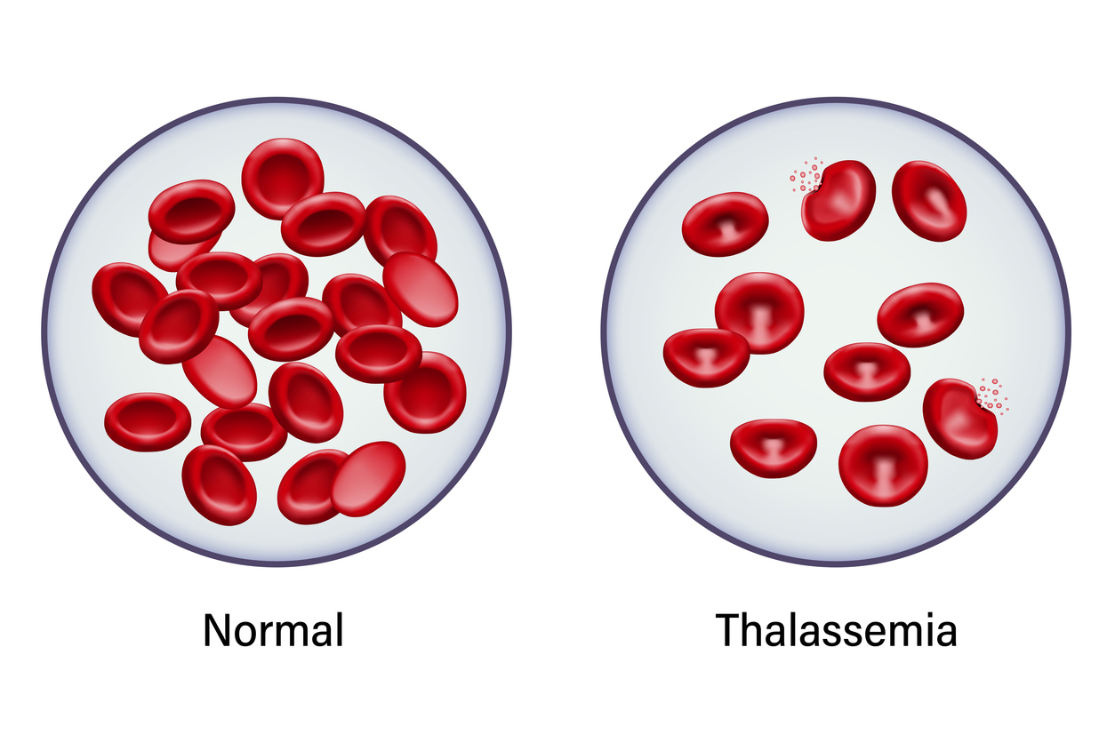 Diagram of comparison between normal red blood cells and thalassemia