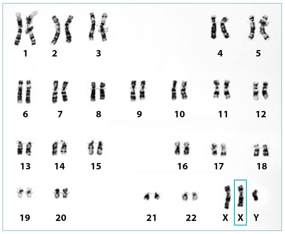 karyotype showing Klinefelter Syndrome | SingHealth