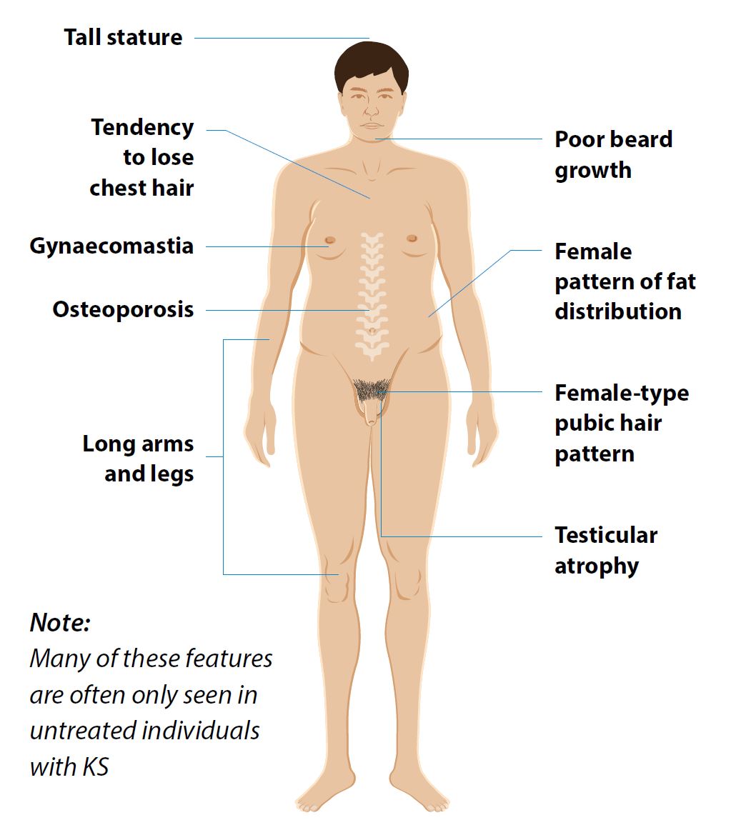 Features of Klinefelter Syndrome | SingHealth