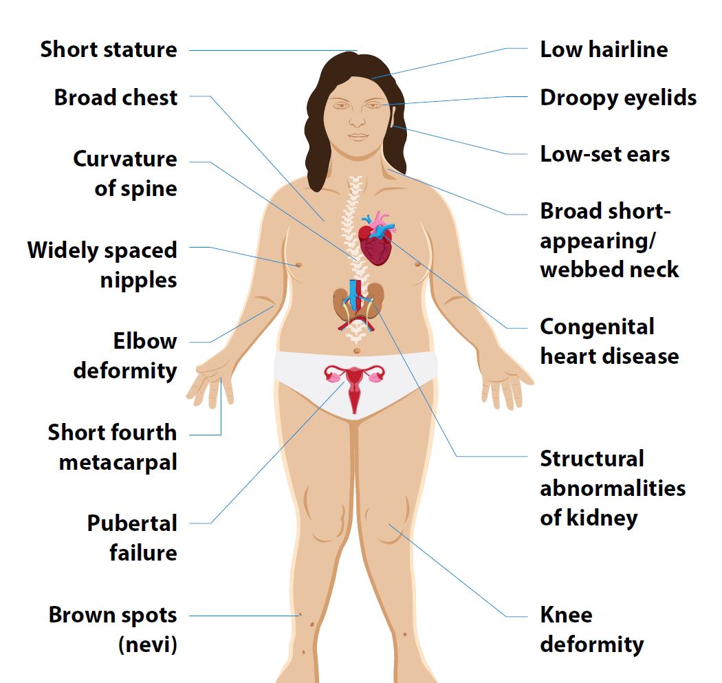 Syndrome of TS