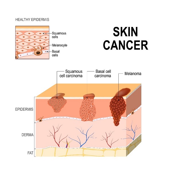  Skin cancer occurs in the epidermis | SingHealth