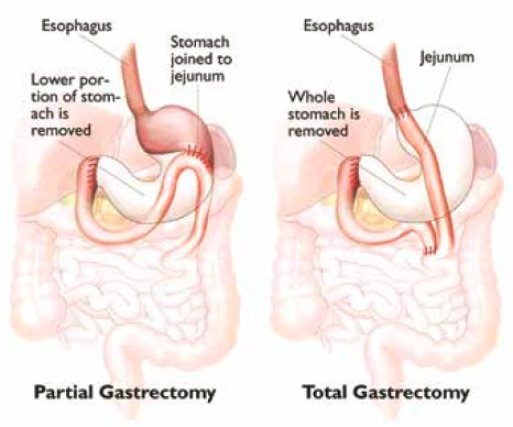gastrectomy for stomach cancer