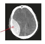 Bleeding from artery (Epidural haematoma)