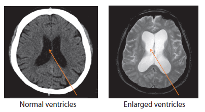 Adult Hydrocephalus Condition and Treatment SingHealth