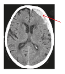 Bleeding from vein (Subdural haematoma)