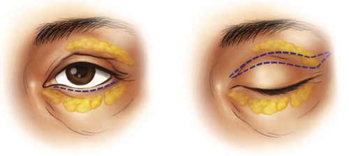 aesthetic eyelid surgery (blepharoplasty)
