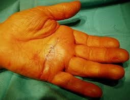 recurrence of trigger finger