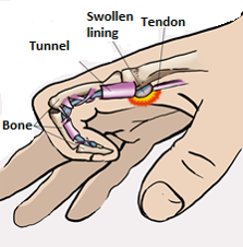 swollen lining inside the finger that causes trigger finger