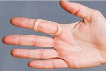 wearing a splint for trigger finger