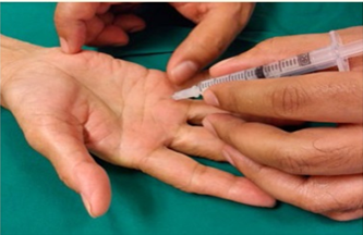 steroid injection to the finger for trigger finger