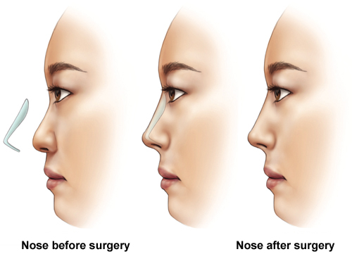 Rhinoplasty procedure - nose before and after surgery