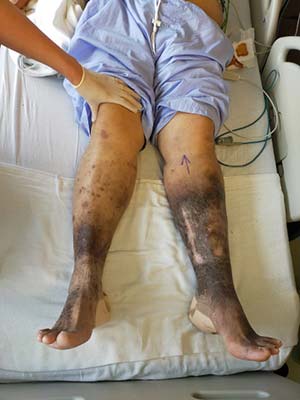 chronic venous insufficiency symptoms