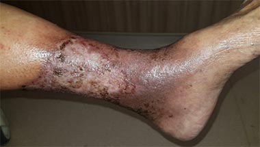 chronic venous insufficiency complications