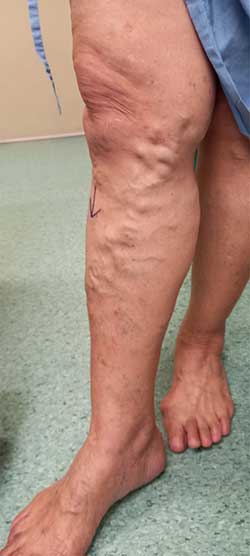 Varicose veins benign