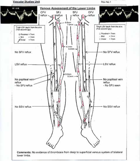 venous duplex ultrasound for diagnosing varicose veins and chronic venous insufficiency